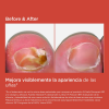 Средство против грибка ногтей SI-NAILS® MicoXpert MD, 4,5 мл. - Исдин